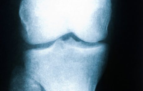 הסקירה החודשית: ירידה  בצפיפות העצם אצל ילדים – osteoporosis
