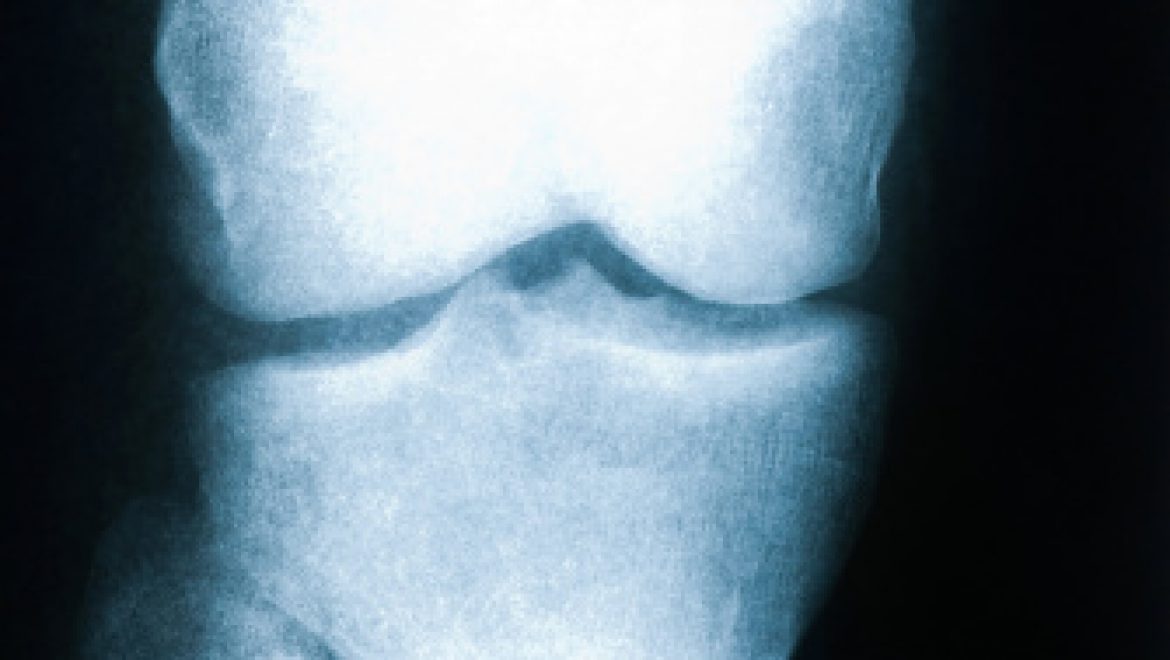 הסקירה החודשית: ירידה  בצפיפות העצם אצל ילדים – osteoporosis