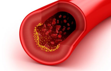מניעה ראשונית של מחלות לב וכלי דם: סקירת עדכון מה-JAMA (שאלת CME)