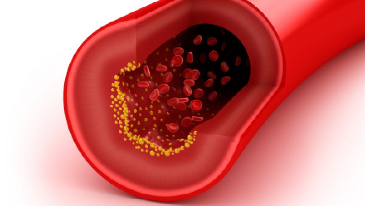 מניעה ראשונית של מחלות לב וכלי דם: סקירת עדכון מה-JAMA