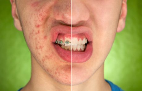 על הקשר בין הכמות היומית של משקאות קלים והופעת  acne vulgaris (פצעי בגרות) בצורה מתונה או חמורה בקרב מתבגרים סיניים (CME)