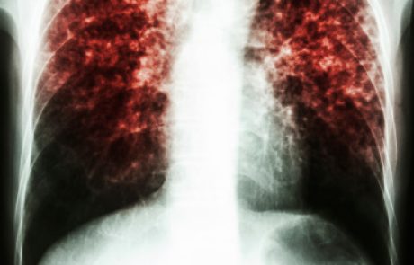 טיפול מונע נגד דלקת ריאות עקב Pneumocystis jirovecii במבוגרים (JAMA)