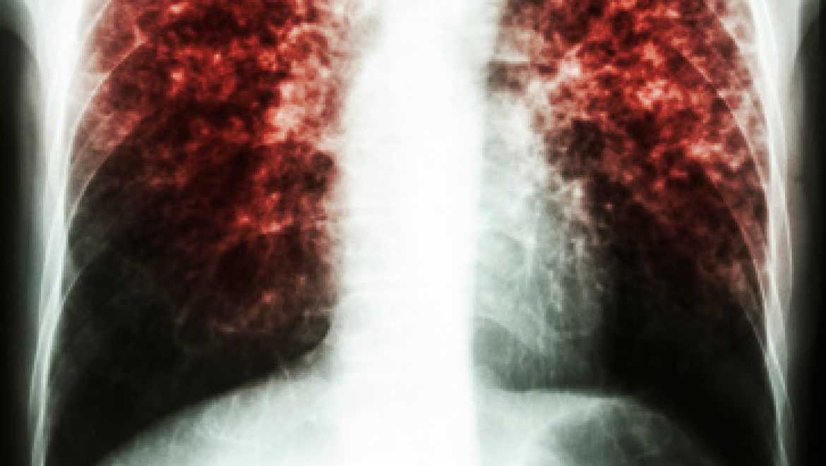 טיפול מונע נגד דלקת ריאות עקב Pneumocystis jirovecii במבוגרים (JAMA)
