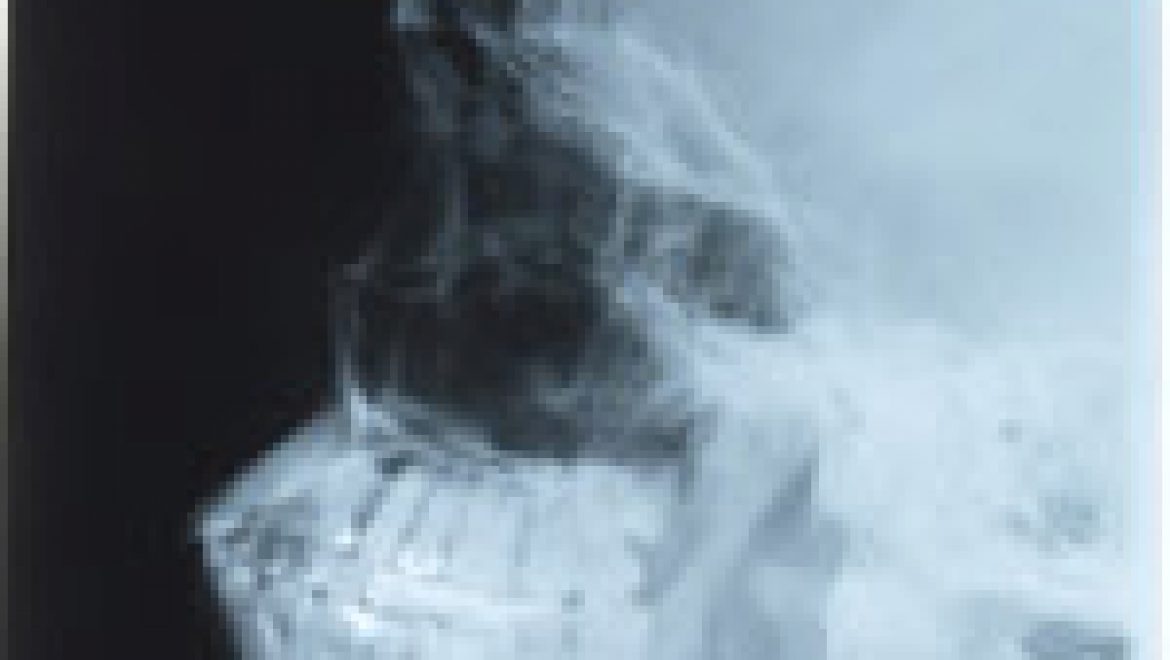 Giant-Cell Arteritis ו-Polymyalgia Rheumatica – דיון מקרה מה-NEJM