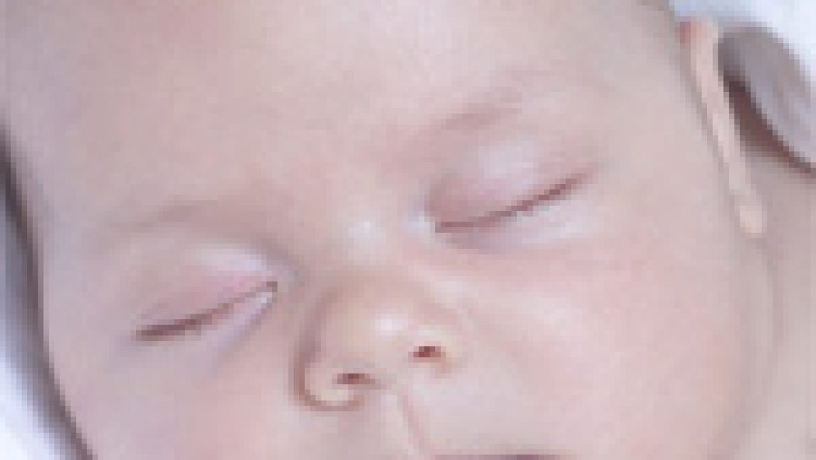 מקרה קצר:  שקע בגולגולת אצל תינוקת בת תשעה חודשים