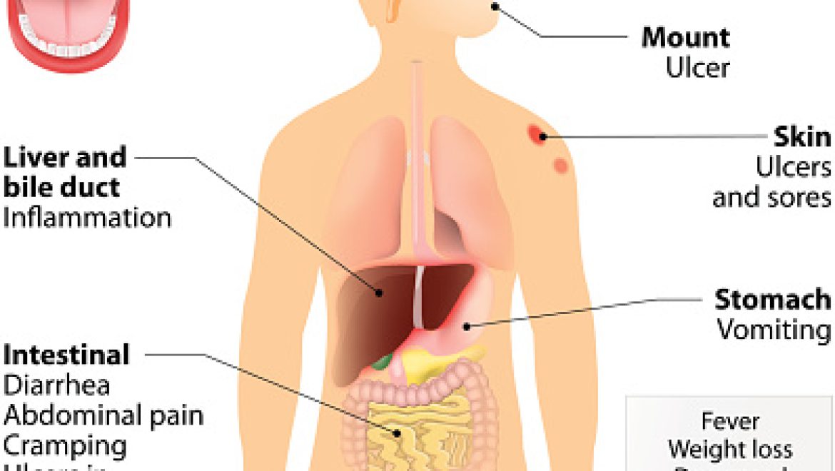 מחלת קרוהן (THE LANCET)